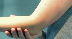 Osteochondritis Dissecans