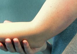 Osteochondritis Dissecans
