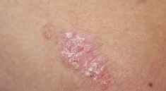 The Impact of Psoriasis on Children’s Lives