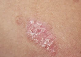 The Impact of Psoriasis on Children’s Lives