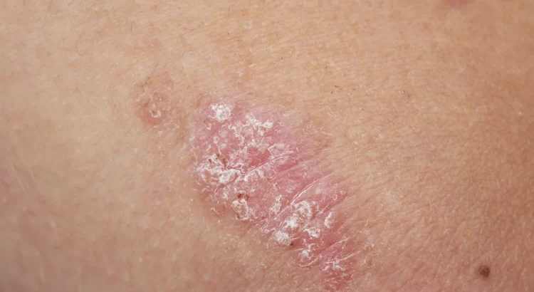 The Impact of Psoriasis on Children’s Lives