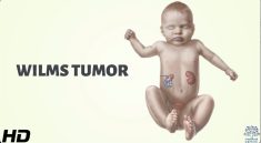 Wilms Tumor in Children