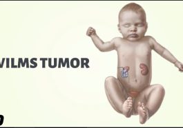 Wilms Tumor in Children