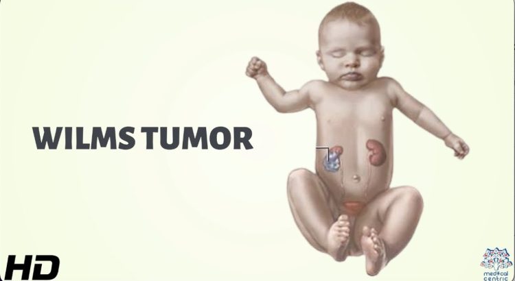 Wilms Tumor in Children