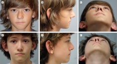 Deviated Nasal Septum in Kids