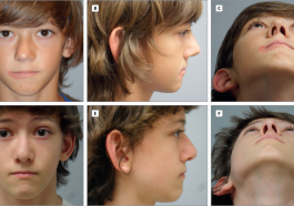 Deviated Nasal Septum in Kids