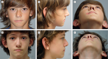 Deviated Nasal Septum in Kids: When to Seek Medical Help