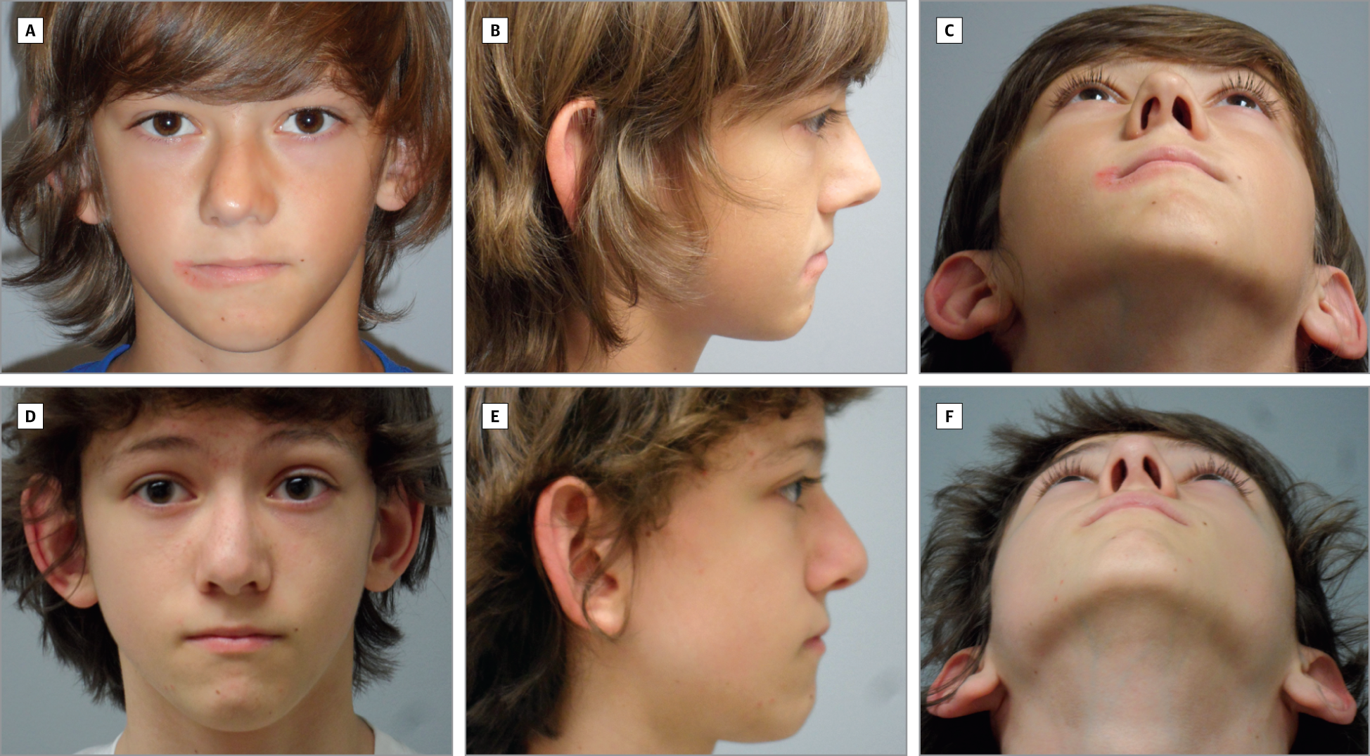 Deviated Nasal Septum in Kids