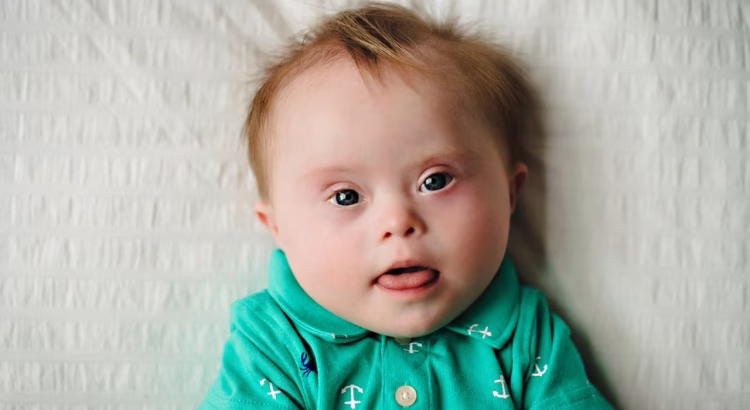 Down Syndrome