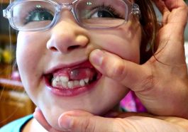 Eruption Cysts in Children