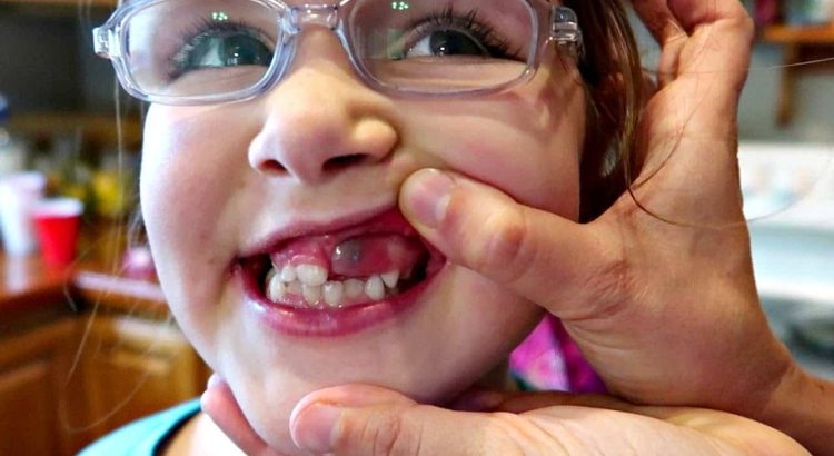 Eruption Cysts in Children