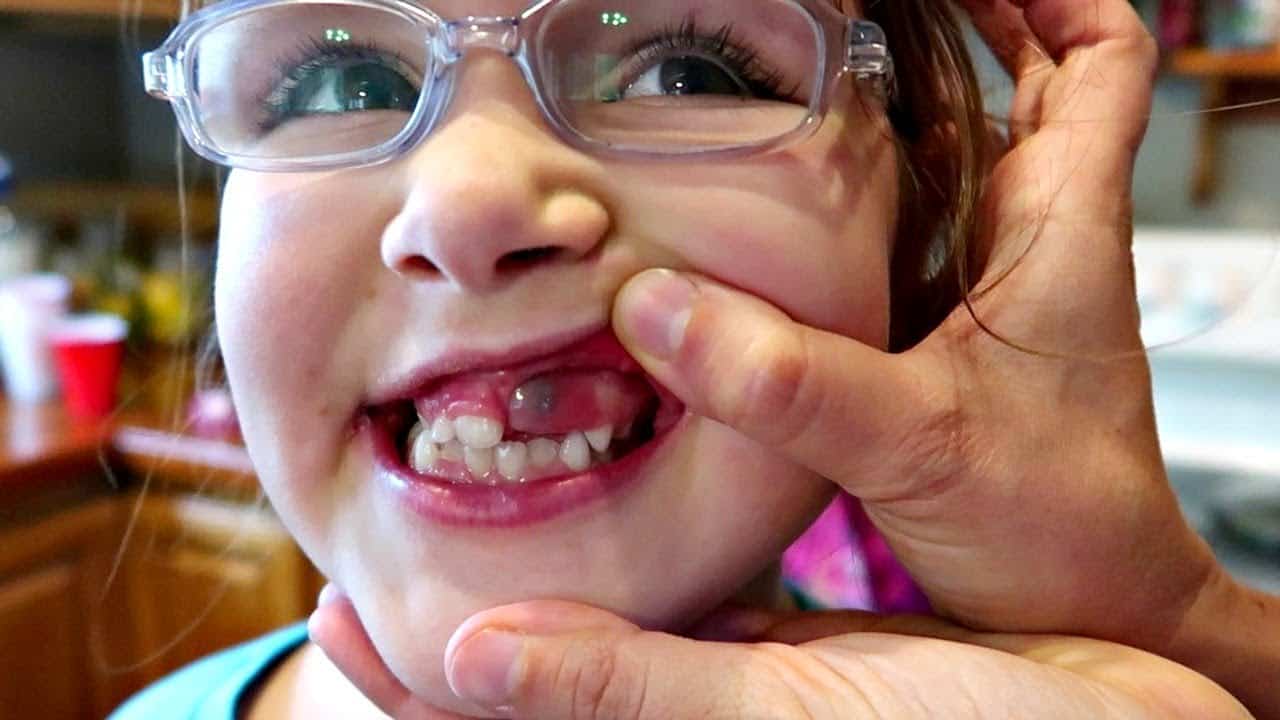 Eruption Cysts in Children
