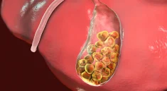 Gallstones in Children