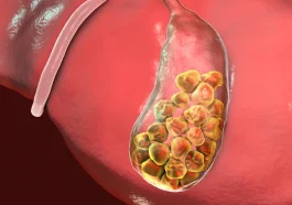 Gallstones in Children