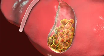 Gallstones in Children: Causes, Symptoms, and Treatment