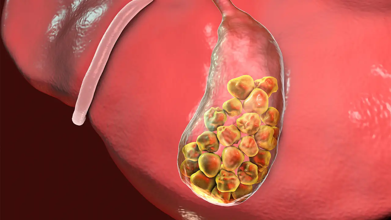 Gallstones in Children