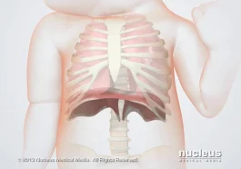 Pulmonary Hypoplasia in Newborns
