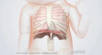 Understanding Pulmonary Hypoplasia in Newborns: A Critical Lung Development Disorder