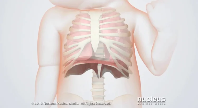 Pulmonary Hypoplasia in Newborns