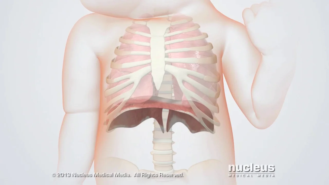 Pulmonary Hypoplasia in Newborns