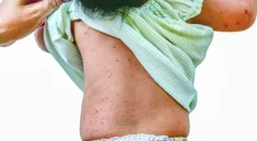 Roseola in Children