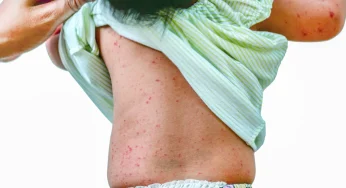 Roseola in Children: Symptoms, Treatment, and Care Tips