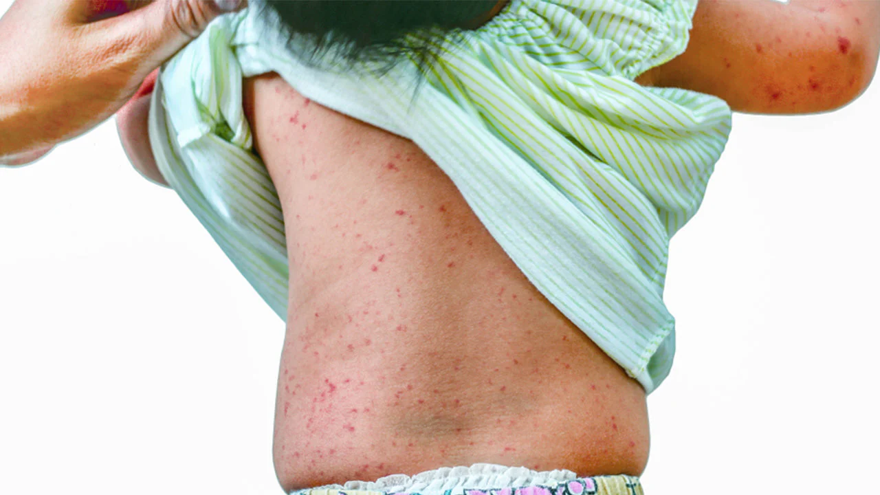 Roseola in Children