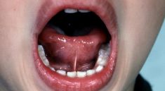 Tongue Tie