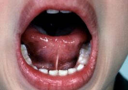 Tongue Tie