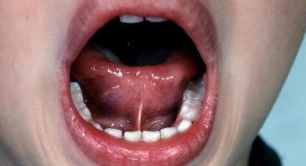 Tongue Tie (Ankyloglossia): Symptoms, Causes, and Treatment Options for Your Child