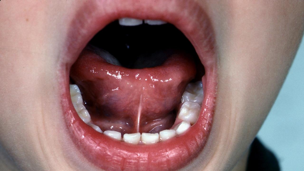 Tongue Tie