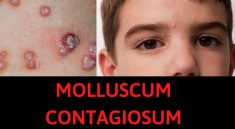 Molluscum Contagiosum