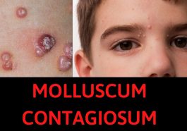Molluscum Contagiosum
