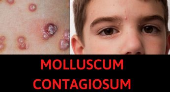 Rashes and Bumps: A Parent’s Guide to Molluscum Contagiosum in Kids
