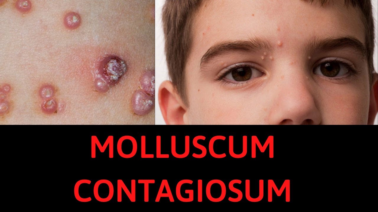 Molluscum Contagiosum