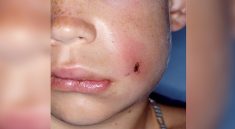 Cheek swelling in children