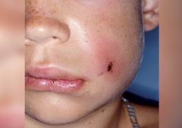 Cheek swelling in children