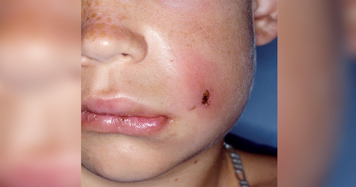 Cheek swelling in children