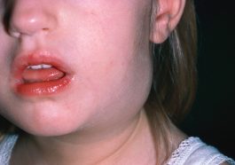 Childhood Lymphadenitis