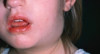 Childhood Lymphadenitis: Early Signs and Effective Care