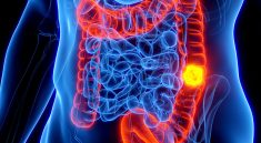 Colon Cancer in Kids