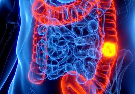 Colon Cancer in Kids