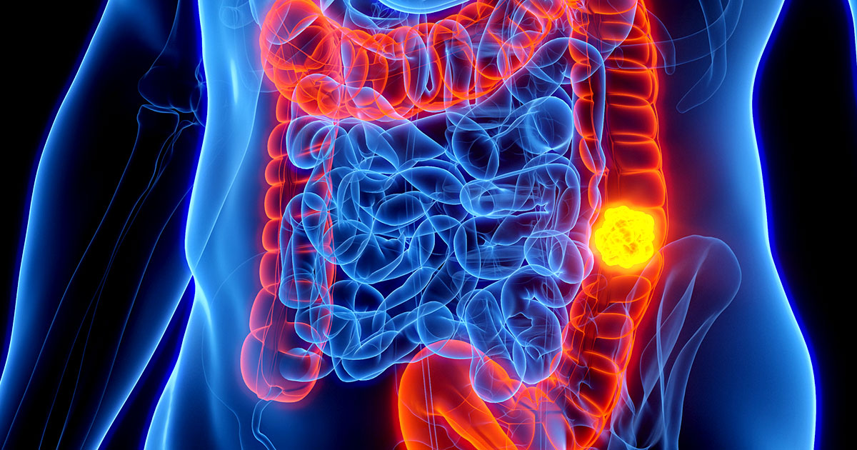 Colon Cancer in Kids