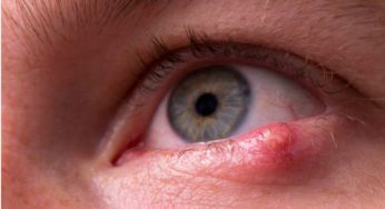 Parents Beware: This Small Eye Lump Might Be a Dangerous Hordeolum!