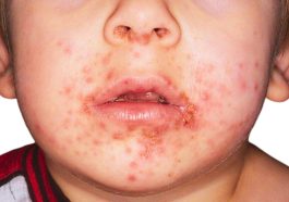 Impetigo