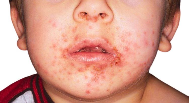 Impetigo