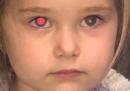 Retinoblastoma in Children