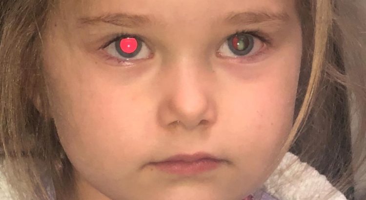 Retinoblastoma in Children