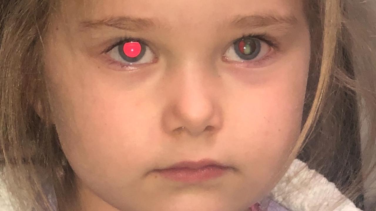 Retinoblastoma in Children