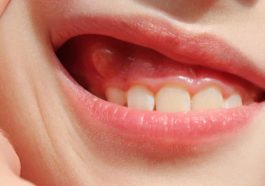 Swollen Gums in Kids